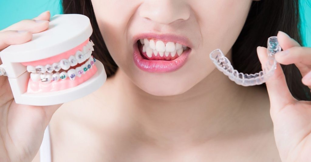 Aligners vs brackets