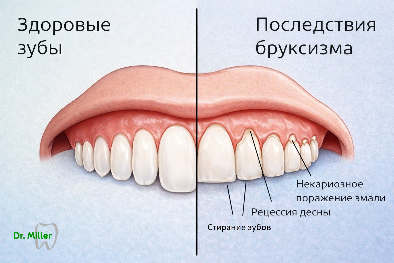 бруксизм