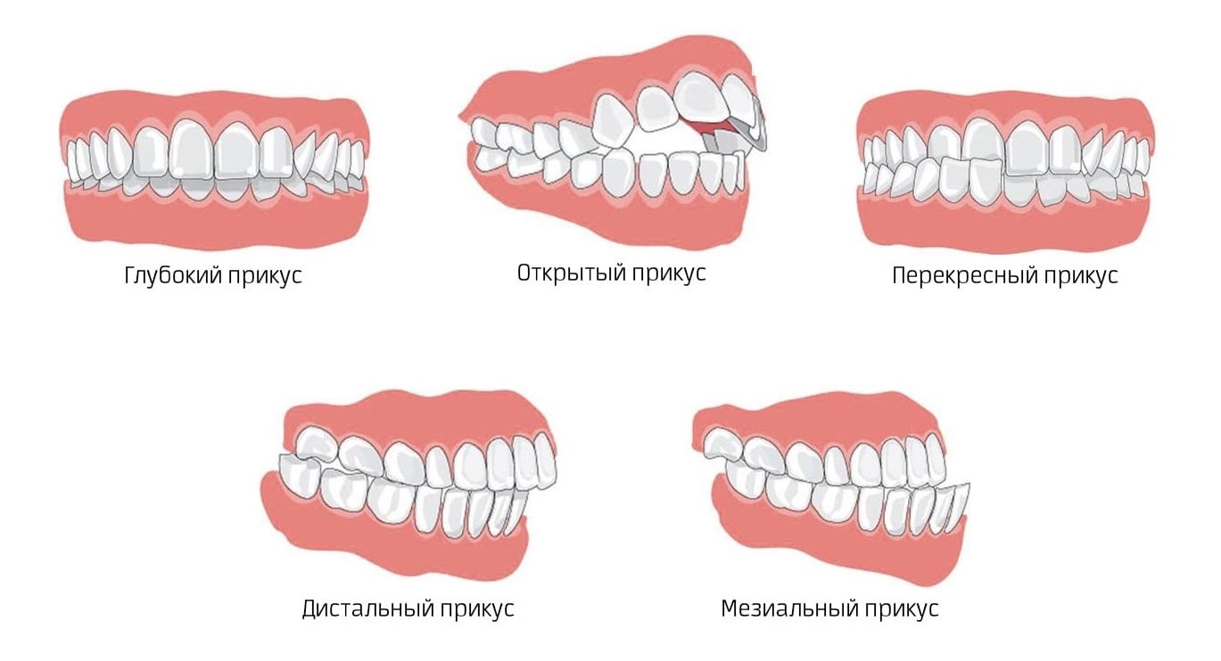 Види прикусу